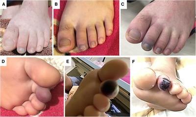 Case report: Endovascular treatment of acute limb ischemia in an adolescent with newly diagnosed lupus